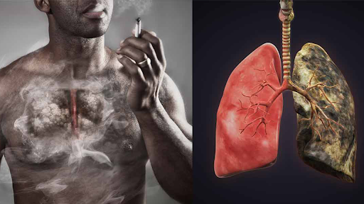 Hút thuốc lá là nguyên nhân của khoảng 90% các trường hợp mắc ung thư phổi